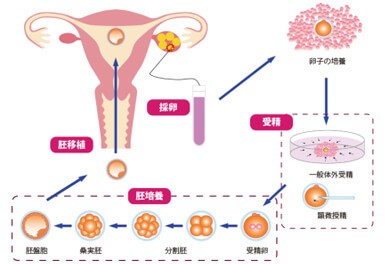 体外受精の解説イラスト図