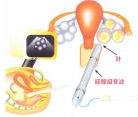 採卵の解説イラスト図