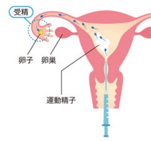 人工授精イラスト図