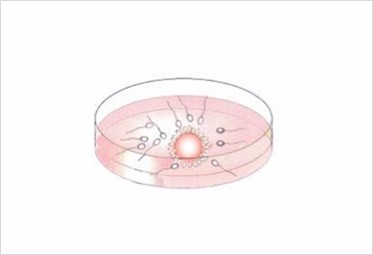 体外受精（IVF）