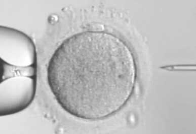 顕微授精（ICSI）